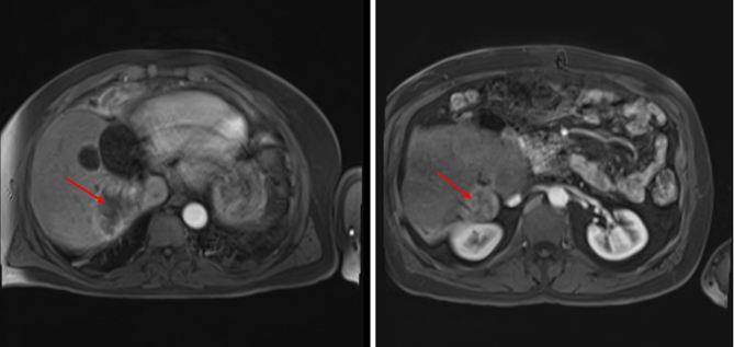 Adrenocortical carcinoma: selective internal radiation therapy and liver metastases.