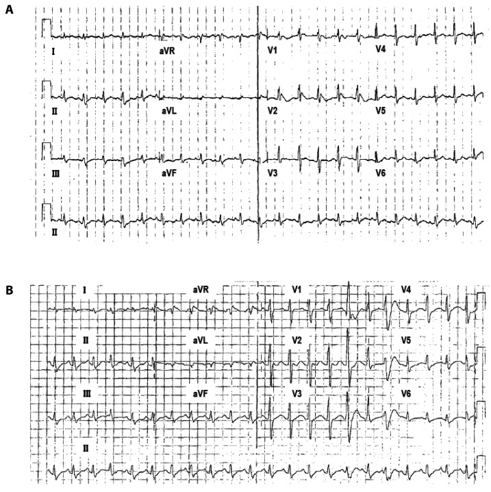 Requirement of β subunit for the reduced voltage-gated Na<sup>+</sup> current of a Brugada syndrome patient having novel double missense mutation (p.A385T/R504T) of <i>SCN5A</i>.