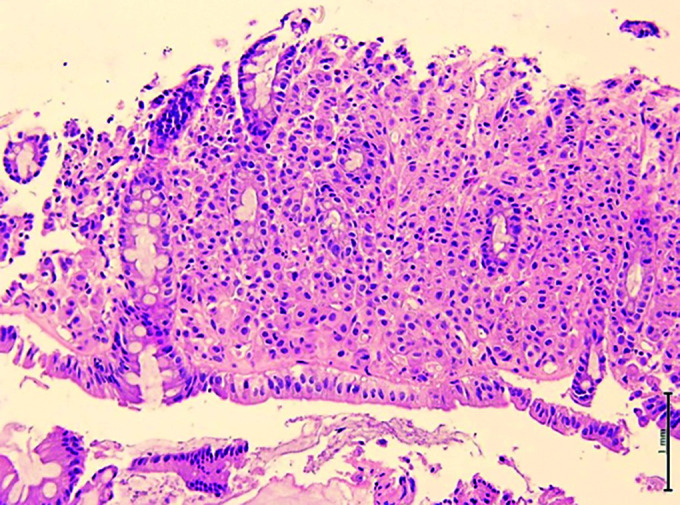 Beyond Boundaries: Breast Cancer Metastasizing to Colon-An Insight into a Rare yet Significant Clinical Scenario: A Case Series.