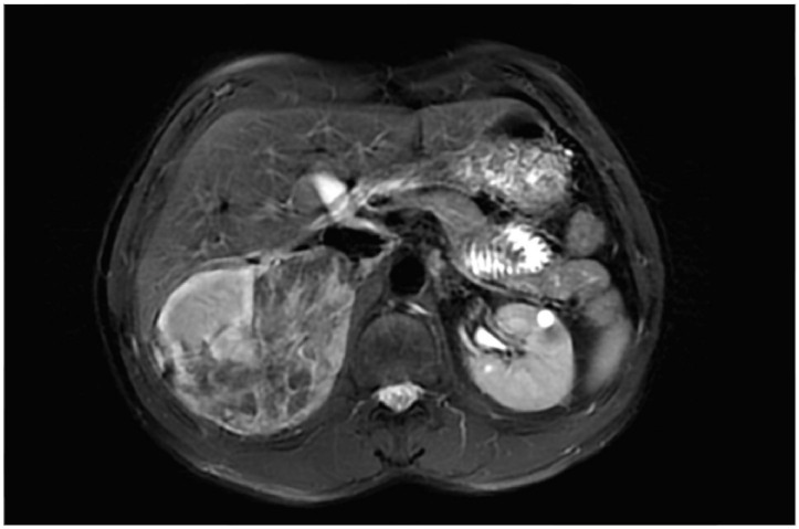 Tuberous Sclerosis Complex and the kidneys: what nephrologists need to know.
