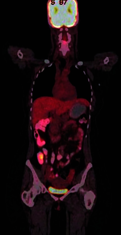 Beyond Boundaries: Breast Cancer Metastasizing to Colon-An Insight into a Rare yet Significant Clinical Scenario: A Case Series.