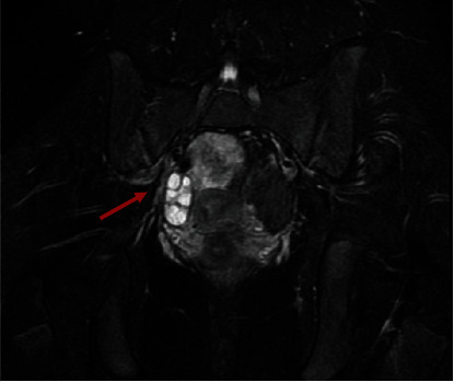Hydatid of Morgagni in Young Female: A Rare Case of Acute Abdomen-Case Report and Literature Review.
