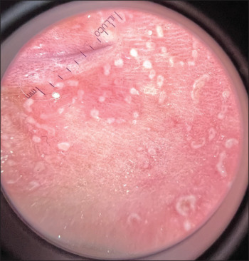 Isolated circinate balanitis successfully treated with topical tacrolimus.