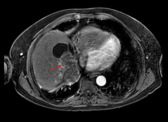 Adrenocortical carcinoma: selective internal radiation therapy and liver metastases.