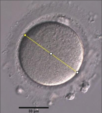 Utilisation of Oocyte Diameter as a Non-invasive Indicator of Oocyte and Embryo Quality: Investigating Protein Kinase B Protein Expression in Cumulus-Granulosa Cells and Embryo Morphokinetics.