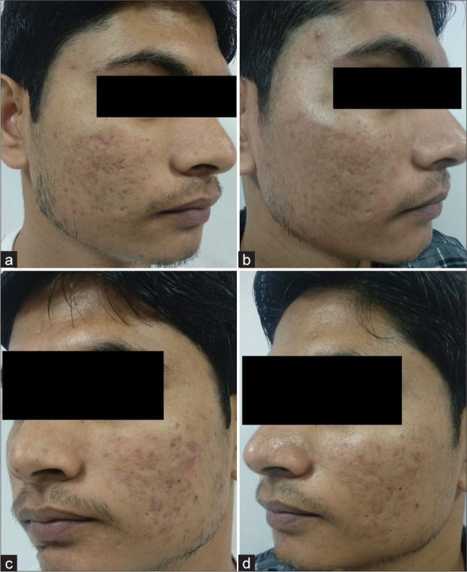 A comparative study of 70% glycolic acid and 30% trichloroacetic acid peel in the treatment of facial atrophic acne scars: A split-face study.