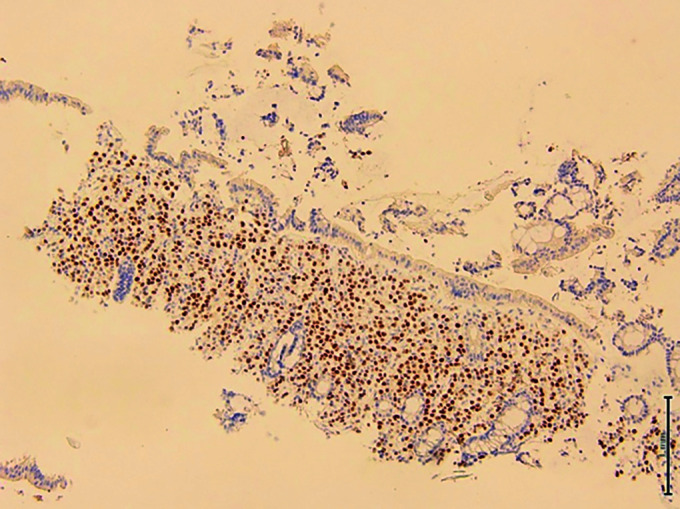 Beyond Boundaries: Breast Cancer Metastasizing to Colon-An Insight into a Rare yet Significant Clinical Scenario: A Case Series.