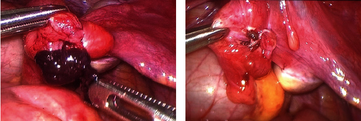 Hydatid of Morgagni in Young Female: A Rare Case of Acute Abdomen-Case Report and Literature Review.
