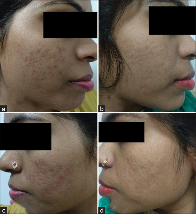 A comparative study of 70% glycolic acid and 30% trichloroacetic acid peel in the treatment of facial atrophic acne scars: A split-face study.