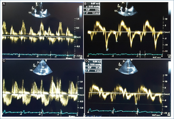 [Factors associated with left ventricular diastolic dysfunction in adults from a region of the Andes in Peru].