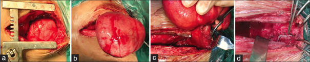 Desmoid Fibromatosis of the Oesophagus Creating an Oesophageal Diverticulum in a 2-year-old Girl.
