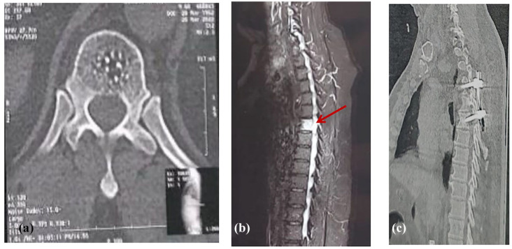 Unusual Presentation of Thoracic Chordoma with Spinal Epidural Hematoma: A Rare Case Report and PRISMA-Driven Systematic Review.