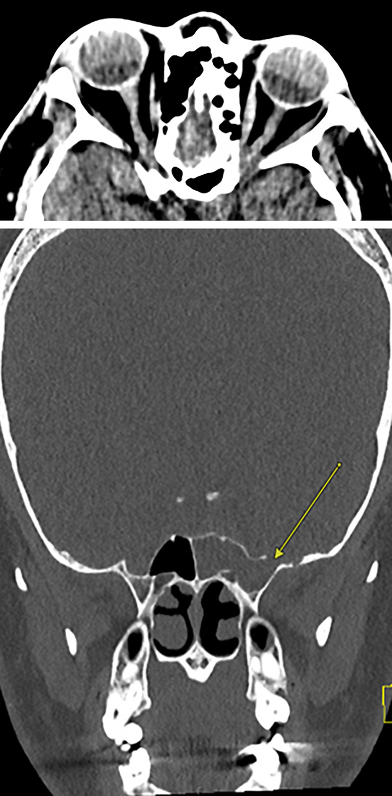 Cerebrospinal Fluid Leak and Idiopathic Intracranial Hypertension in a Transgender Male: Is Intracranial Hypertension Hormonally Mediated?