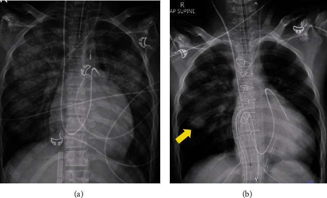 Overcoming Double Jeopardy: Successful Orthotopic Heart Transplant in a Recipient With Bacterial and Fungal Infections.