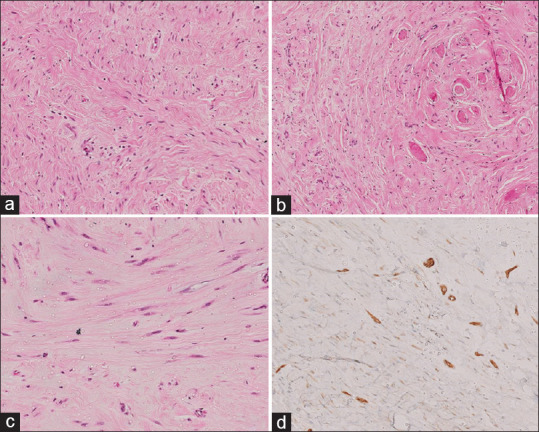 Desmoid Fibromatosis of the Oesophagus Creating an Oesophageal Diverticulum in a 2-year-old Girl.