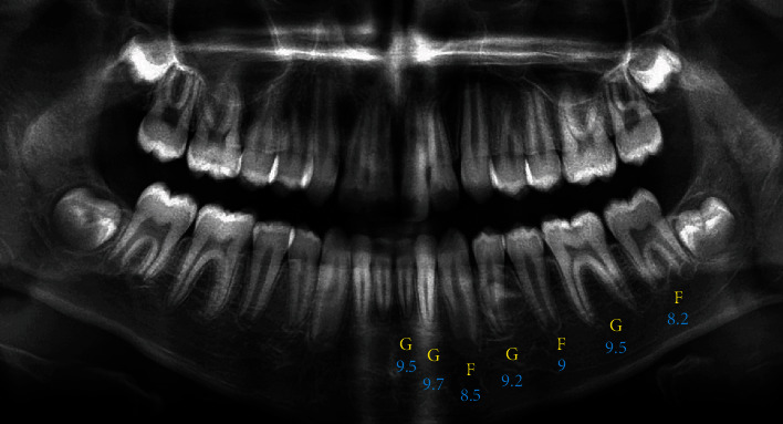 Radiological Evaluation of the Accuracy of Demirjian, Nolla, and Willems Methods for Dental Age Estimation in 3-17-Year-Old Iranian Children.