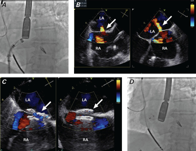 Iatrogenic Atrial Septal Defect After MitraClip Transcatheter Edge-to-Edge Repair: To Close or Not to Close?