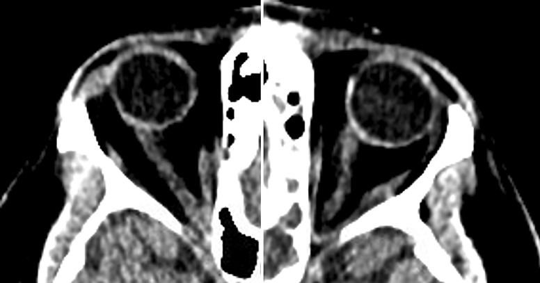 Cerebrospinal Fluid Leak and Idiopathic Intracranial Hypertension in a Transgender Male: Is Intracranial Hypertension Hormonally Mediated?