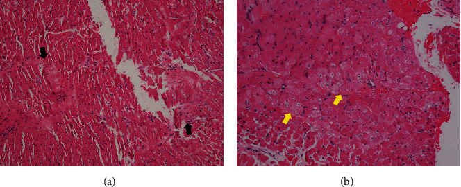 Overcoming Double Jeopardy: Successful Orthotopic Heart Transplant in a Recipient With Bacterial and Fungal Infections.