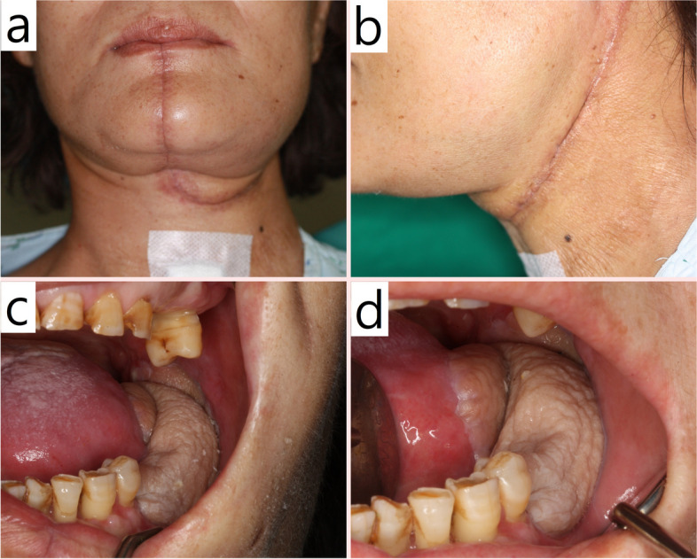 Efficacy of tracheostomy for respiratory management in patients with advanced oral cancer.