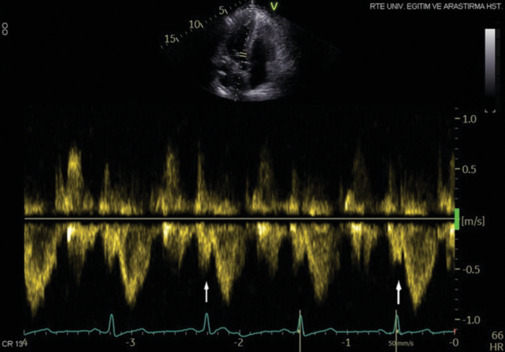 Independent Relationship between Ankylosing Spondylitis and Presystolic Wave Detected on Echocardiography.