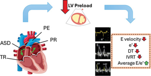 Noninvasive Assessment of Left Ventricle Filling Pattern in Patient with Severe Tricuspid Regurgitation, Pulmonary Regurgitation, Atrial Septal Defect, and Pulmonary Embolism.