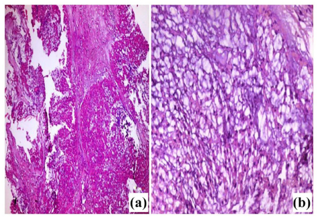 Unusual Presentation of Thoracic Chordoma with Spinal Epidural Hematoma: A Rare Case Report and PRISMA-Driven Systematic Review.