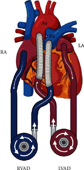 Overcoming Double Jeopardy: Successful Orthotopic Heart Transplant in a Recipient With Bacterial and Fungal Infections.
