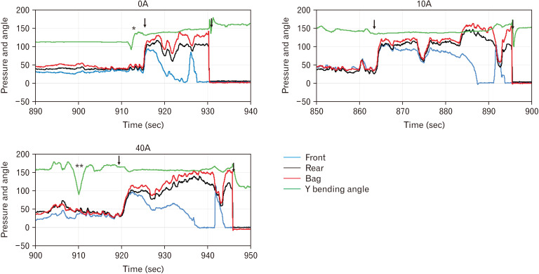 Consistency of Feces Affects Defecatory Function.