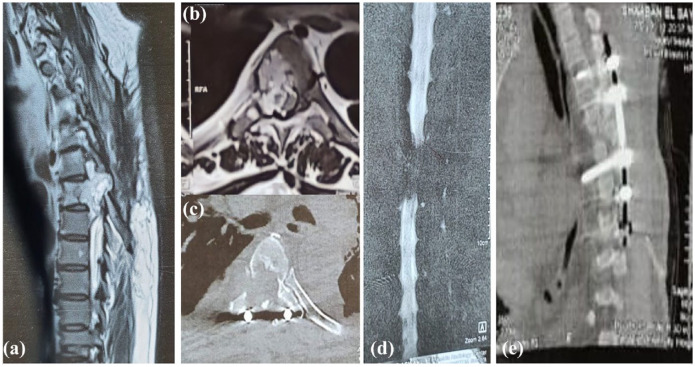 Unusual Presentation of Thoracic Chordoma with Spinal Epidural Hematoma: A Rare Case Report and PRISMA-Driven Systematic Review.