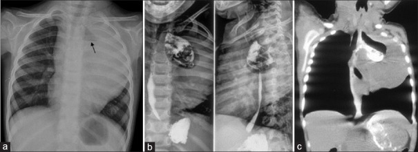 Desmoid Fibromatosis of the Oesophagus Creating an Oesophageal Diverticulum in a 2-year-old Girl.