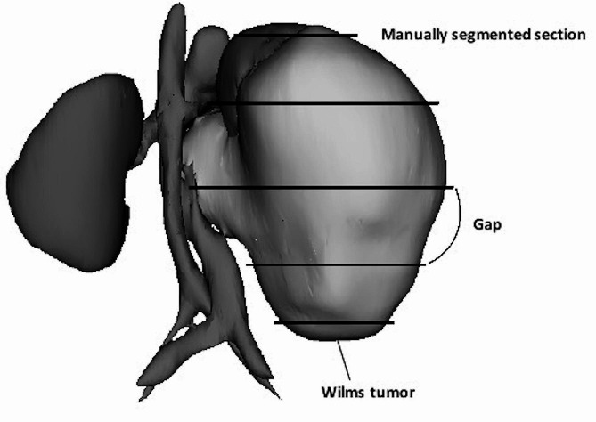 Automation of Wilms' tumor segmentation by artificial intelligence.