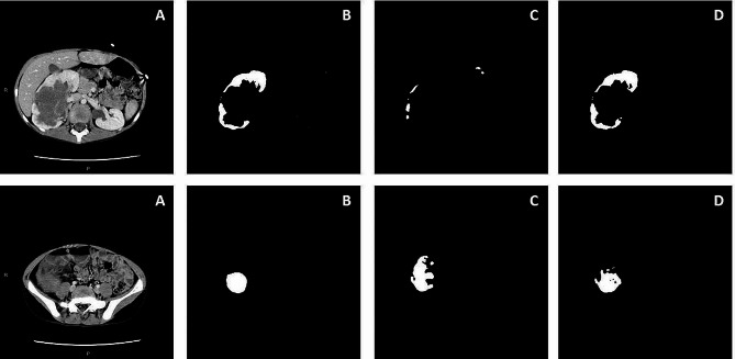 Automation of Wilms' tumor segmentation by artificial intelligence.