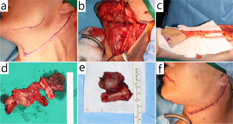 Efficacy of tracheostomy for respiratory management in patients with advanced oral cancer.