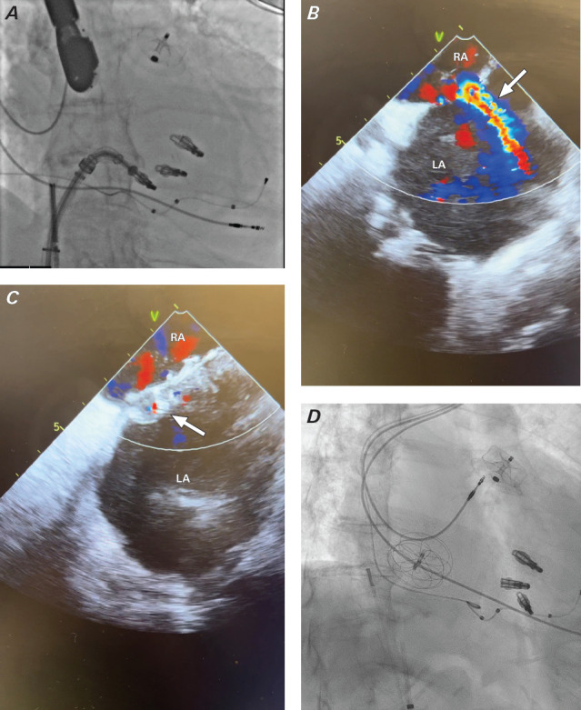 Iatrogenic Atrial Septal Defect After MitraClip Transcatheter Edge-to-Edge Repair: To Close or Not to Close?