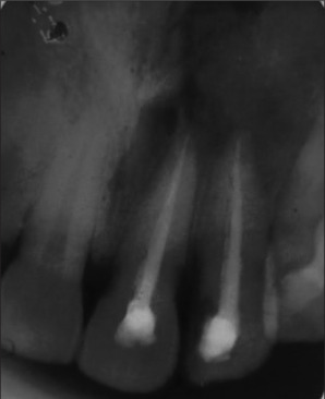Maxillary mucormycosis masquerading as an endodontic-periodontal lesion.