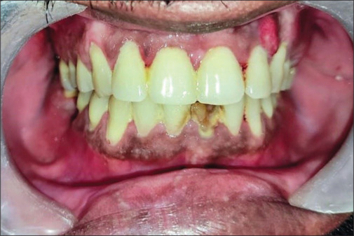 Maxillary mucormycosis masquerading as an endodontic-periodontal lesion.