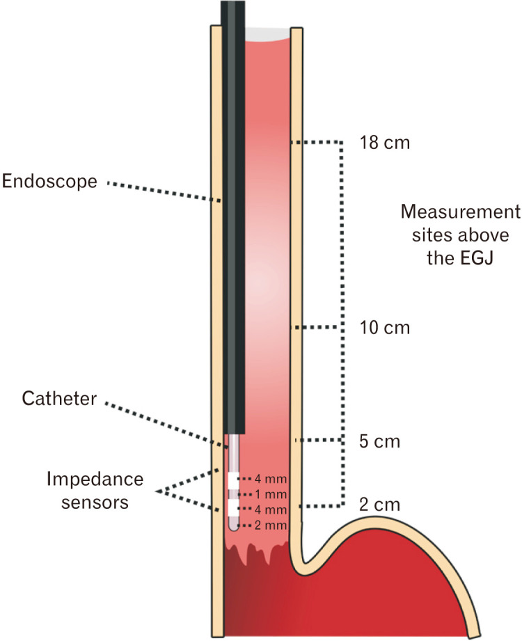 Esophageal Mucosal Impedance Assessment for the Diagnosis of Gastroesophageal Reflux Disease.