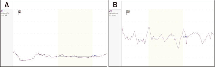 Esophageal Mucosal Impedance Assessment for the Diagnosis of Gastroesophageal Reflux Disease.