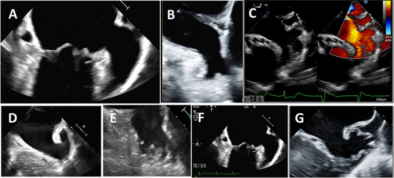 Morphological and functional assessment of the left atrial appendage in daily practice: a comprehensive approach using basic and advanced echocardiography with practical tips.