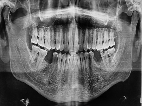 Maxillary mucormycosis masquerading as an endodontic-periodontal lesion.