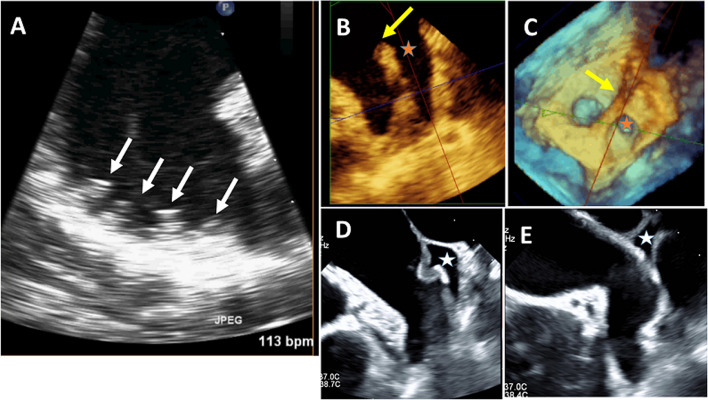 Morphological and functional assessment of the left atrial appendage in daily practice: a comprehensive approach using basic and advanced echocardiography with practical tips.
