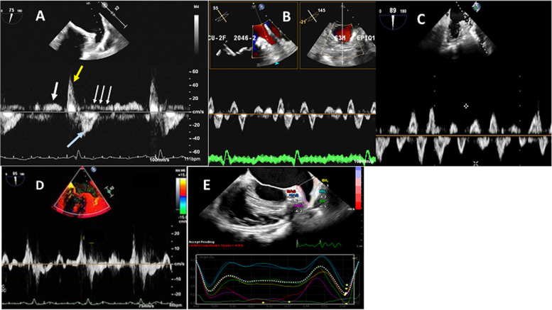 Morphological and functional assessment of the left atrial appendage in daily practice: a comprehensive approach using basic and advanced echocardiography with practical tips.