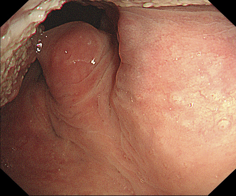 EUS-FNA to diagnose a submucosal oropharyngeal carcinoma.