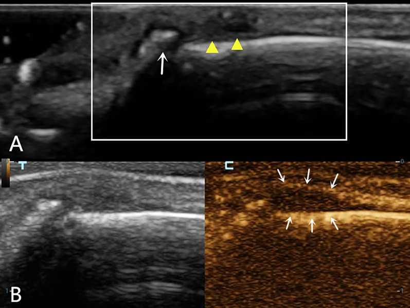 Applicability of combined high-frequency and contrast-enhanced ultrasound in finger extensor tendon injuries: three case reports.