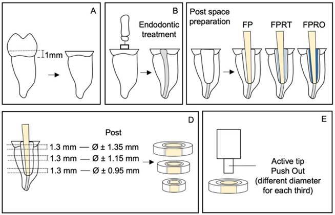 Relined fiberglass posts: influence of resin opacity on the bond strength to intraradicular dentin.