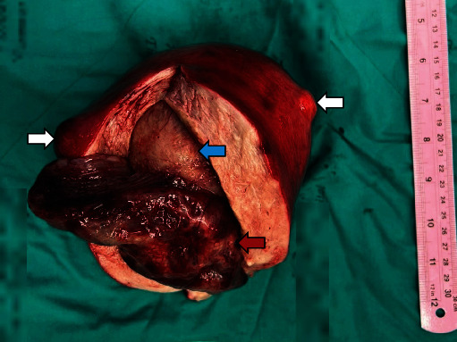 Fifteen-Centimeter Giant Tamoxifen-Associated Endometrial Polyp Presenting With Constipation: A Case Report and Review of the Literature.