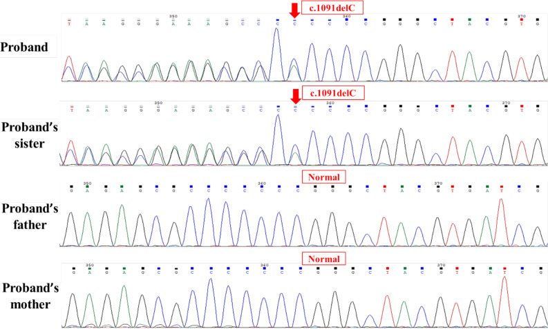 A Case Report of Parental Germline Mosaicism in the <i>PCDH19</i> Gene of Two Iranian Siblings.