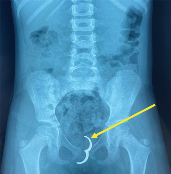 Intravaginal Foreign Body: A Rare Cause of Persistent Vaginal Discharge in a Child.