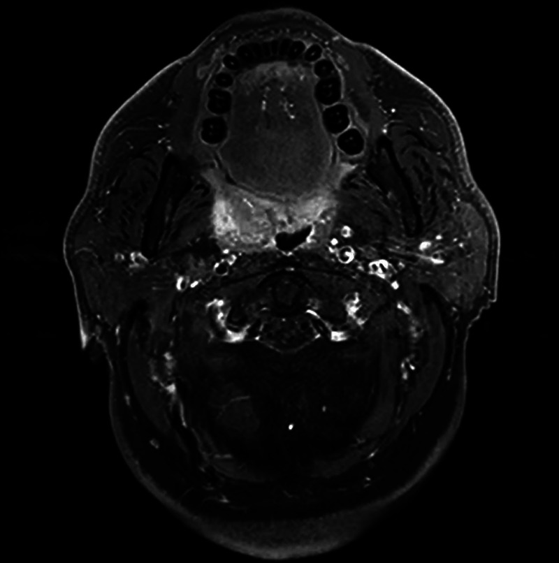 EUS-FNA to diagnose a submucosal oropharyngeal carcinoma.